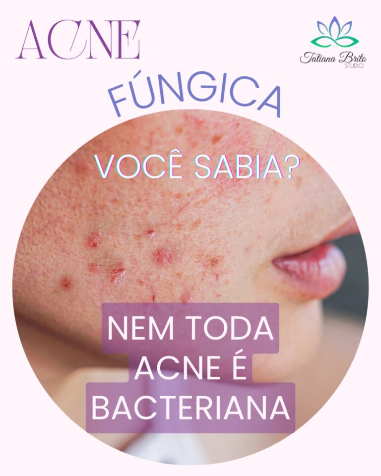 Acne fúngica: o que é e como tratamos aqui no Studio