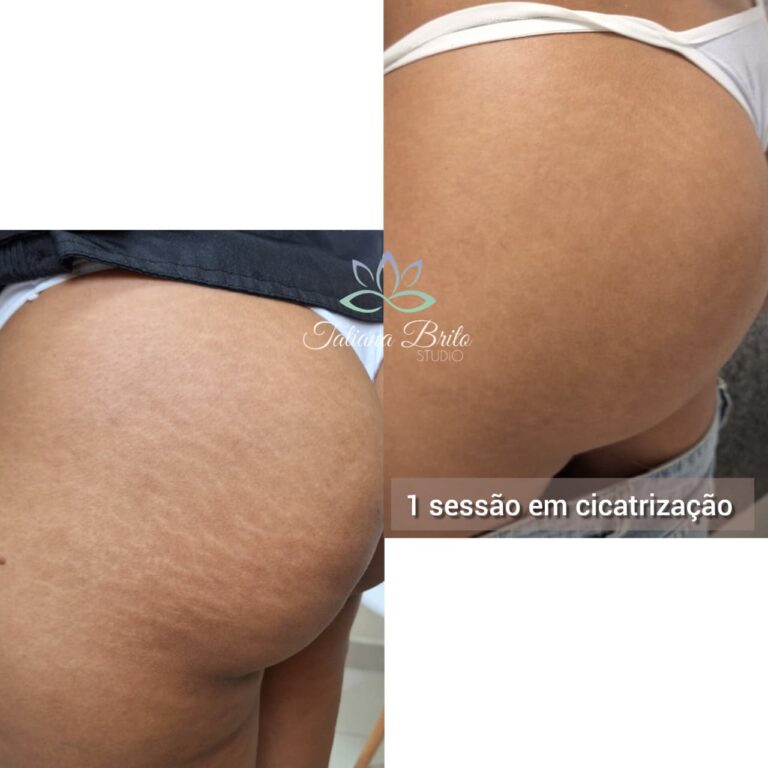Camuflagem de estrias: como funciona e quem pode fazer?
